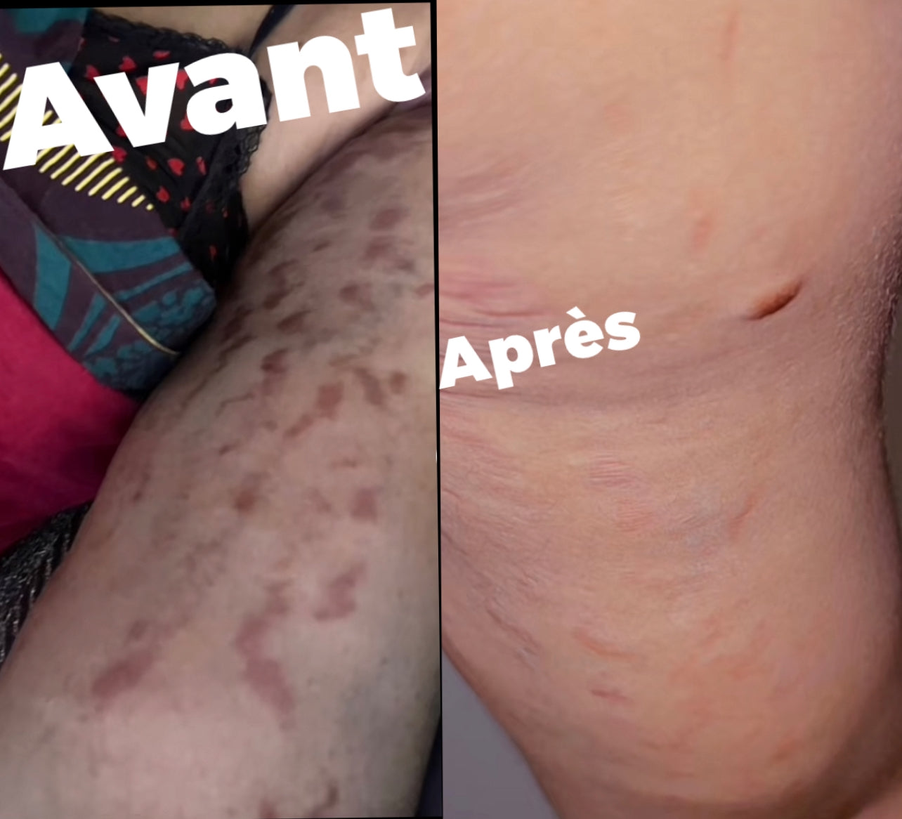 STRETCH MARKS SET ( Amazing)