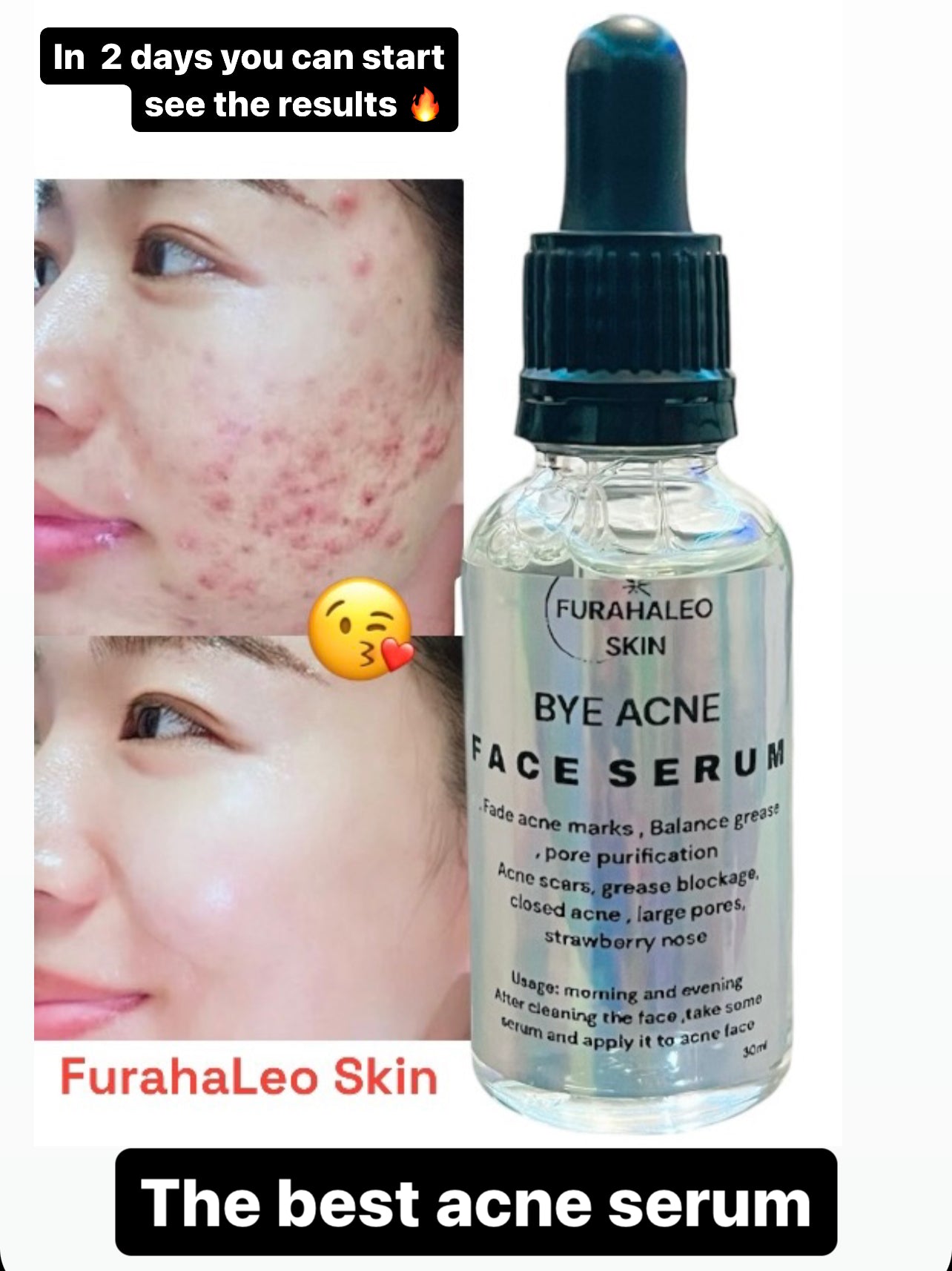 BYE ACNE