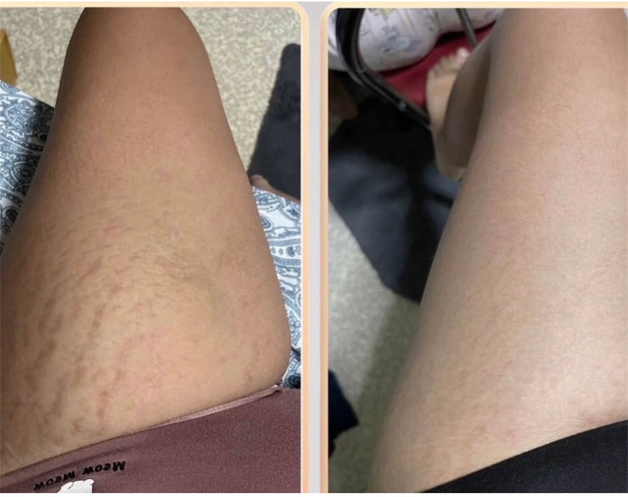 our cream remove stretch mark , look our customer before and after